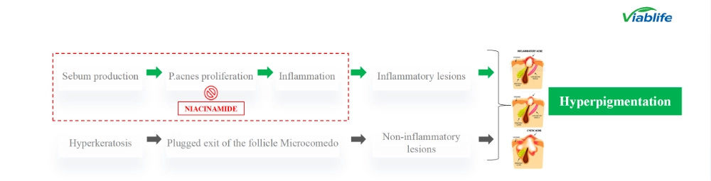 여드름 관리에 니코틴아마이드 사용 Nicotinamide in Acne Management