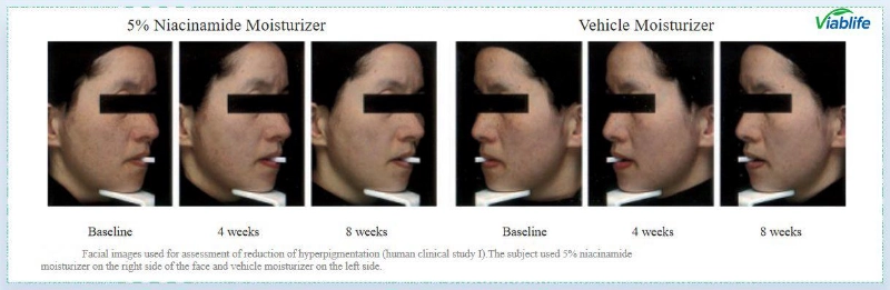 피부 미백을 위한 니코틴아마이드 Nicotinamide for Skin Brightening